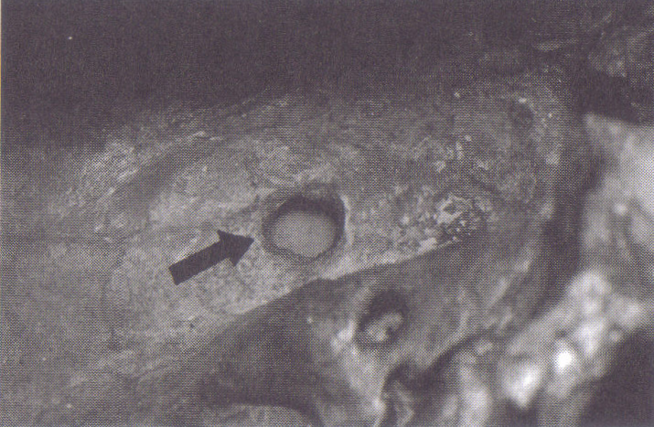 Broken Hill Man 3
